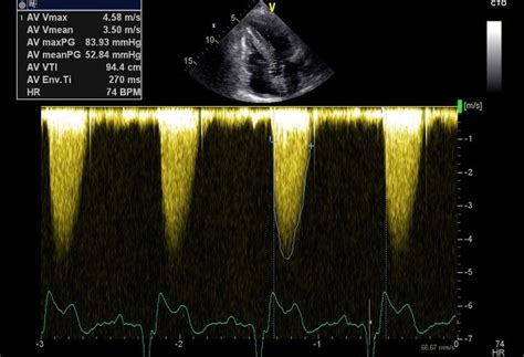 Aortic Valve Stenosis Grading