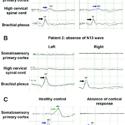 Somatosensory evoked potentials of the median nerve. The evoked ...