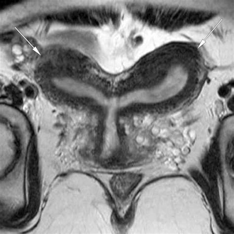 Bicornuate uterus as seen on a coronal MRI (normal variant) | Radiology, Mri, Bicornuate uterus