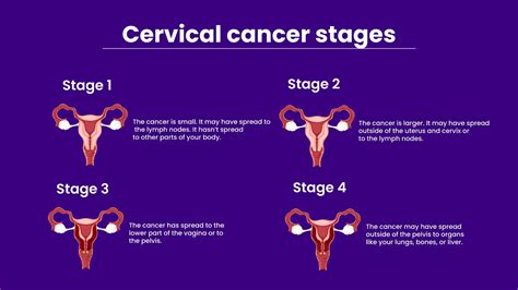 Cervical Cancer: What is it, Symptoms, Stages, Treatment