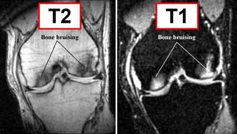 Bone Bruise - Causes, Symptoms, Diagnosis, Treatment & Healing Time