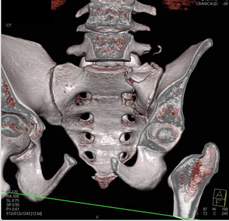 Sacral and Symphysis Fractures with Pelvic Hematoma in 3D Display ...