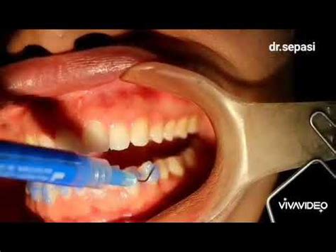 Indirect Bonding orthodontics brackets - YouTube