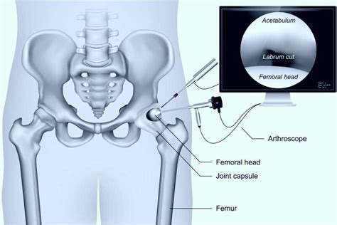 Hip Arthroscopy | Hip Scope Surgeon | Manhattan, New York, NY