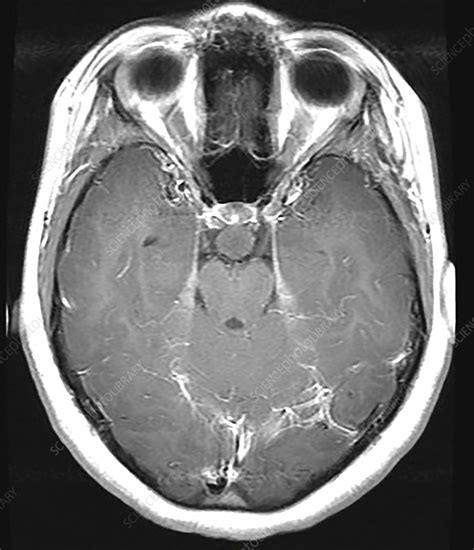 Hypothalamic Hamartoma, MRI - Stock Image - C030/6385 - Science Photo ...