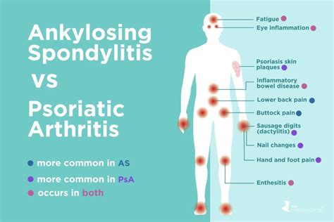 Ankylosing Spondylitis vs. Psoriatic Arthritis: Differences in Symptoms ...