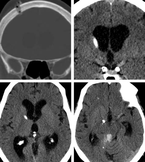 External Ventricular Drain | The Neurosurgical Atlas