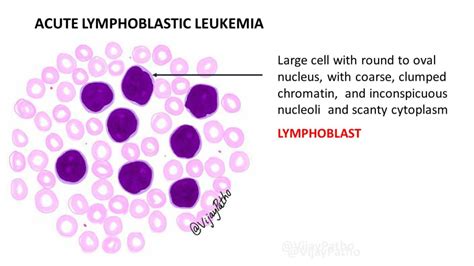 Peripheral smear findings in Leukemia - Illustrated - Pathology Made Simple