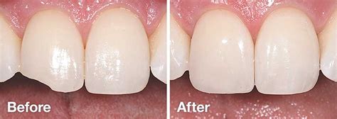 Tooth Bonding | Dr. Charles Picchioni | Bryn Mawr PA