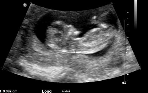 Ultrasound and Pregnancy: The First Trimester | Diagnostic Imaging Centers Blog