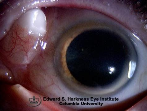 Protruding Scleral Buckle | Vagelos College of Physicians and Surgeons