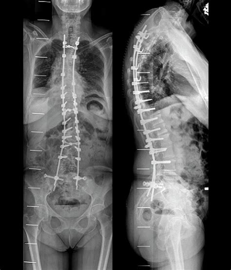 Curvature Of The Spine After Surgery Photograph by Zephyr - Pixels