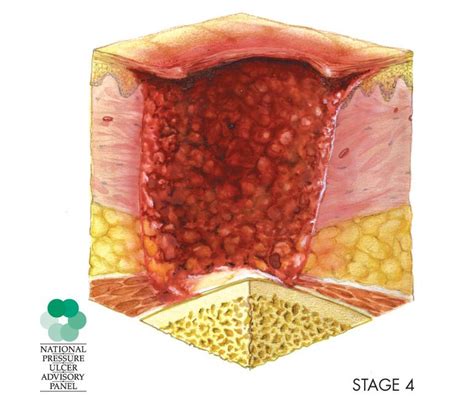 Pressure Ulcers After Surgery: Risk Factors and Prevention