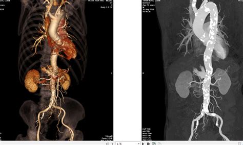 VIETNAMESE MEDIC ULTRASOUND: CASE 565: SUPRARENAL AORTIC ANEURYSM, Dr ...