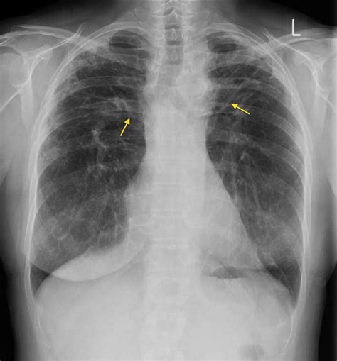 Sarcoidosis - Radiology at St. Vincent's University Hospital