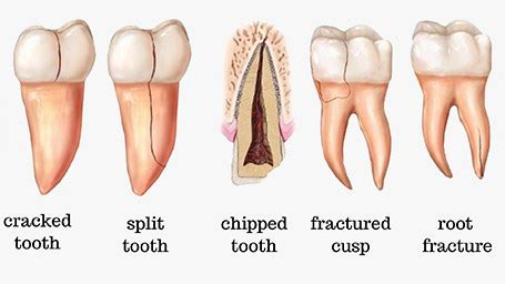 Cracked Tooth Symptoms, Treatments, and Recovery | Endodoncia Tracy ...