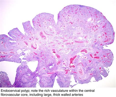 Pathology Outlines - Endocervical polyp