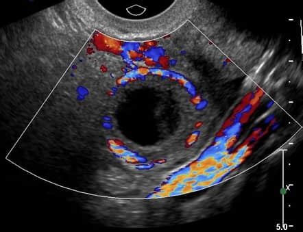 Ring of fire 🔥 RI Corpus Luteum > 0.5 Ectopic Pregnancy