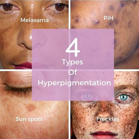 There are 4 main types of hyperpigmentation. PIH -post inflammatory hyperpigmenta… | Post ...