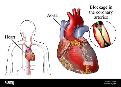 Coronary Artery Bypass Graft: Anatomy Stock Photo - Alamy