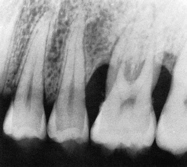 31: Radiographic Aids in the Diagnosis of Periodontal Disease | Pocket ...