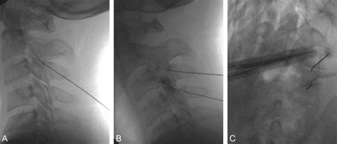 Cervical Facet Joint Nerve Injection