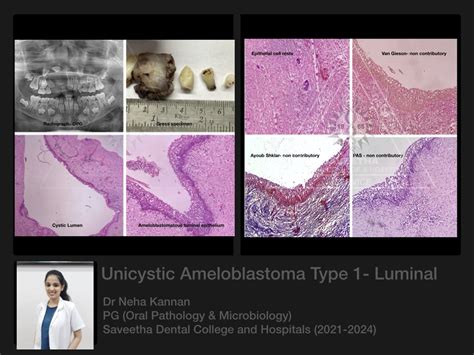 Unicystic Ameloblastoma Histology