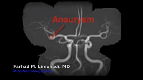 Brain Aneurysm Surgery: Surgical clipping of an MCA aneurysm which could not be coiled. - YouTube