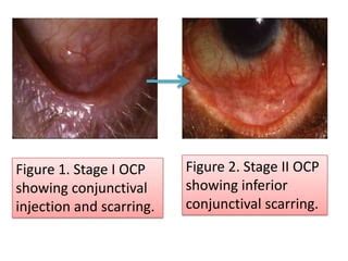 Ocular Cicatricial Pemphigoid