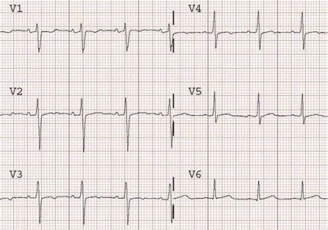 T wave • LITFL • ECG Library Basics