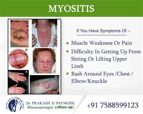 Myositis - Marin Wick