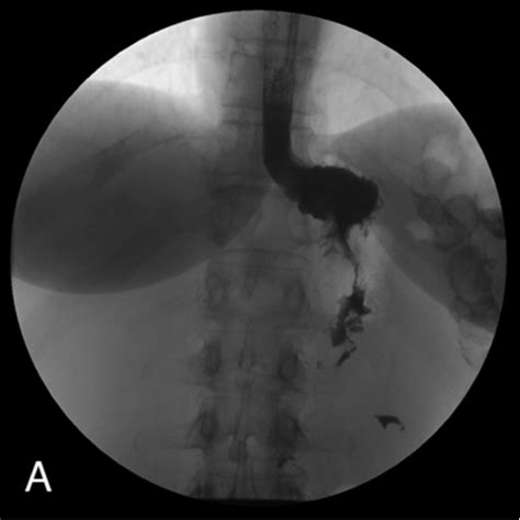 Complications of marginal ulceration. Fluoroscopic images from the ...