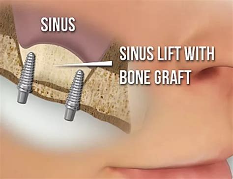 Teeth Club - Bone Graft & Sinus Lift