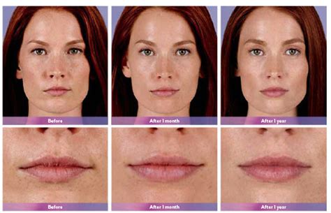 JUVÉDERM ® Ultra Plus XC Doylestown Lip Enhancement Bucks County