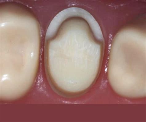 Indirect Restorations: Metal-Ceramic (PFM) Crown Prep. Upper 1st Premolar