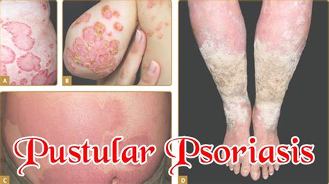 Pustular Psoriasis - How To Treat Pustular Psoriasis Naturally ! - YouTube