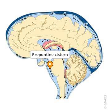 Prepontine cistern - e-Anatomy - IMAIOS