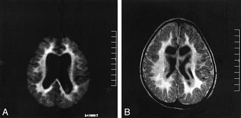 Metachromatic Leukodystrophy. Causes, symptoms, treatment Metachromatic Leukodystrophy