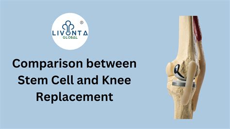 Comparison between Stem Cell and Knee Replacement