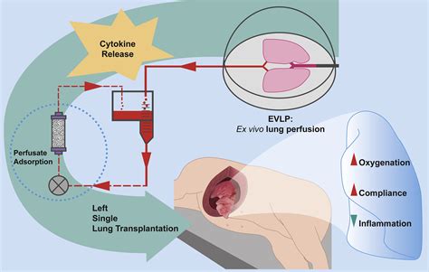 Perfusate adsorption during ex vivo lung perfusion improves early post ...