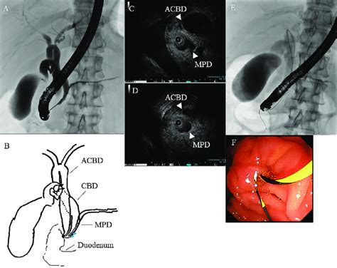 Endoscopic retrograde cholangiopancreatography (ERCP) and intraductal... | Download Scientific ...