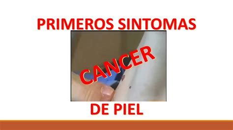 Cancer De Piel Sintomas