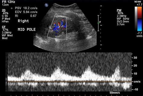 Doppler Basics | Vascular Medicine | Diagnostic medical sonography, Vascular ultrasound, Sonography