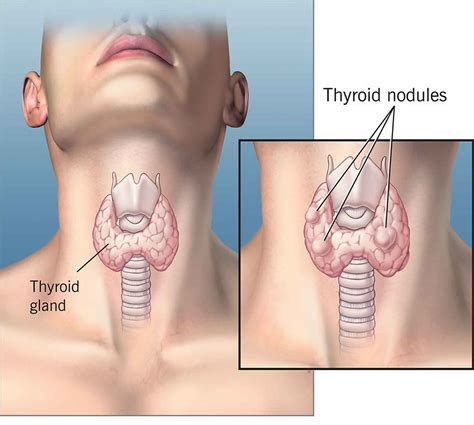 Solitary thyroid nodule causes, symptoms, diagnosis, treatment & prognosis