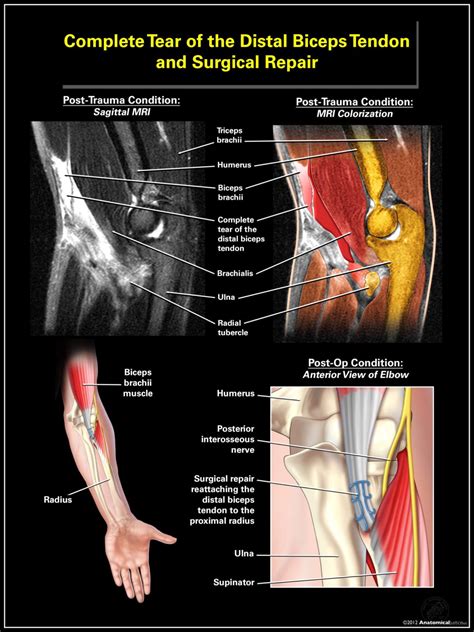 Complete Tear of the Distal Biceps Tendon and Surgical Repair