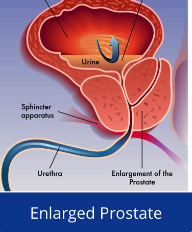 what's the best treatment for an enlarged prostate