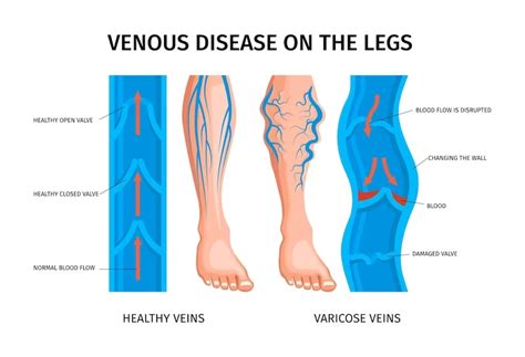 What do you understand by varicose veins