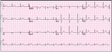 STEMI with Dual Culprit Lesions | Resus Review