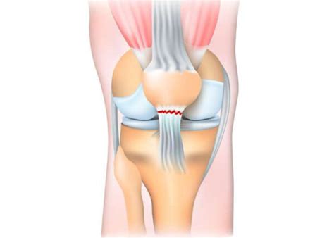 Patellar Tendon Repair Reconstruction| Knee Doctor | Sugar Land, Pearland, Houston, Texas