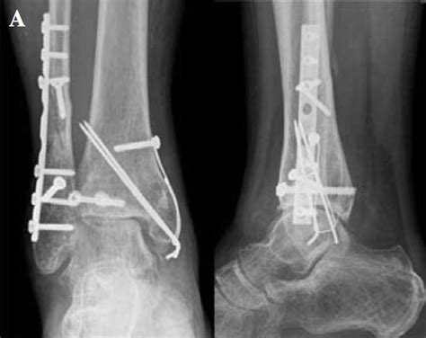 Triple Artrodese : Triple Arthrodesis Technique: Approach ...